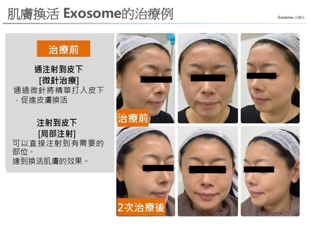 肌膚換活 Exosome的治療例