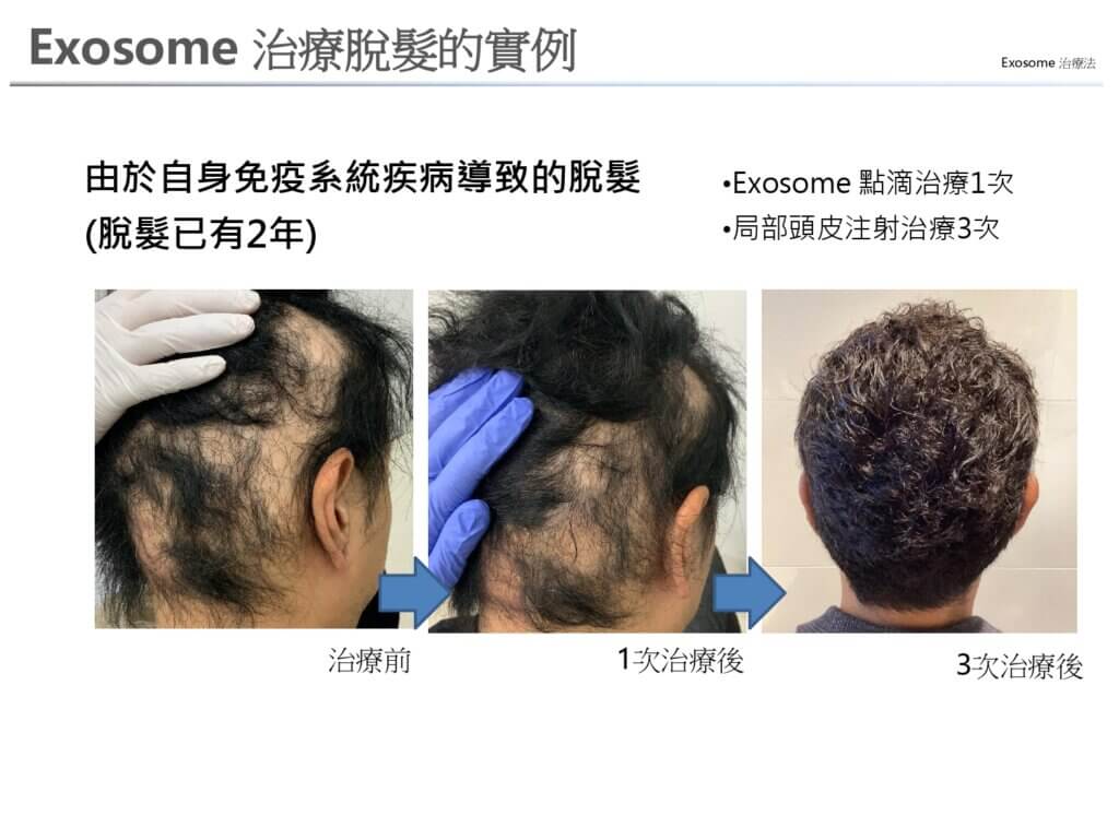 #Exosome 治療脫髮的實例